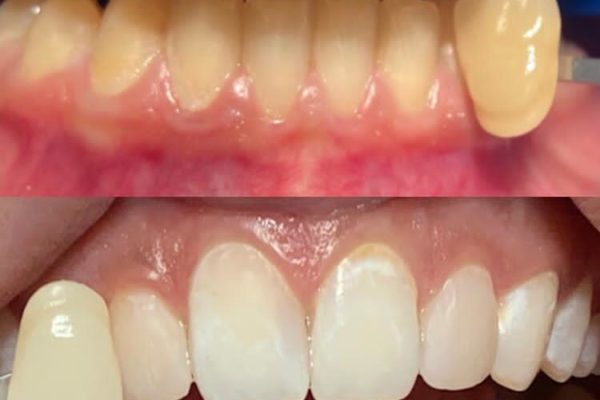 In-Office-Bleaching – mit weißen Zähnen in den Frühling