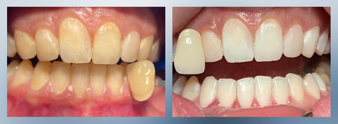 Zwei geöffnete Münder, links vor und rechts nach der Bleaching-Behandlung, wobei das linke Gebiss deutlich gelblicher erscheint als das rechte.